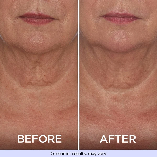 Before and after neck skin